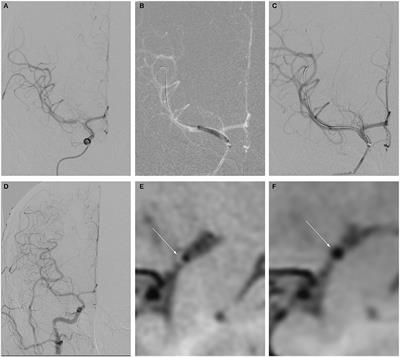 Drug-Coated Balloon-Oriented Angioplasty for Severe Symptomatic Atherosclerotic MCA Stenosis in Young Adults